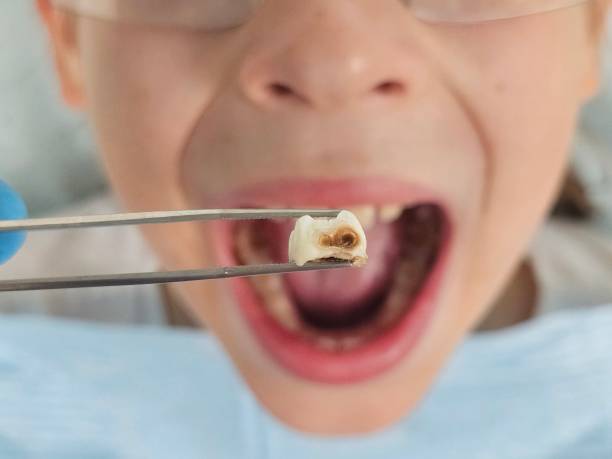 Best Emergency Tooth Extraction in North Olmsted, OH